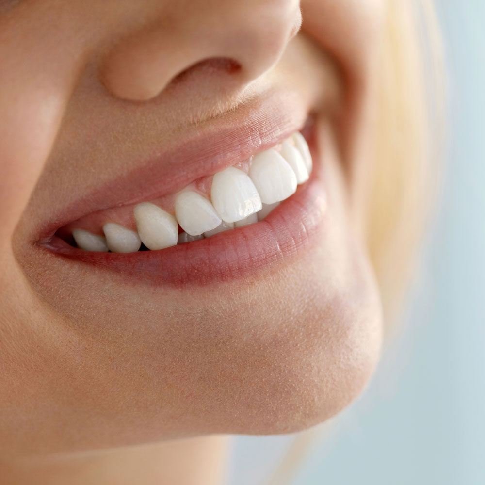 3-Sbiancamento-Dentale-Professionale-a-Vicenza--Studio-Dentistico-Zocca