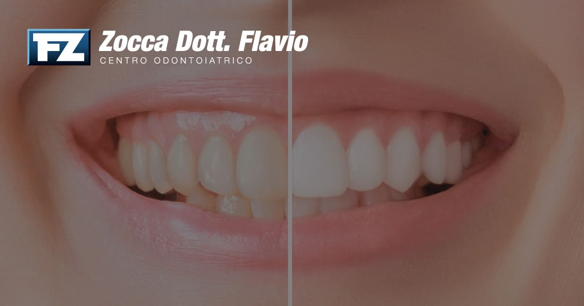 Cos'è lo Sbiancamento Dentale e Come Funziona nel Dettaglio